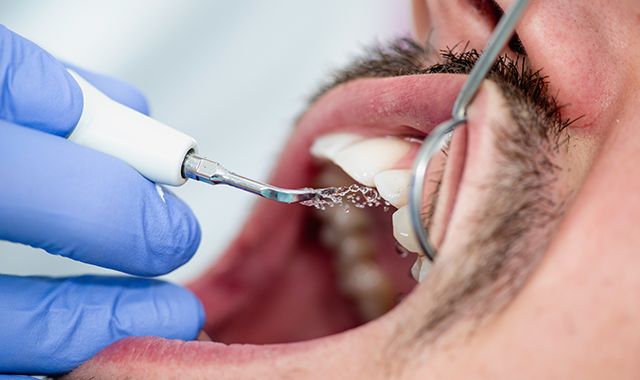 Clearing the fog over misconception, confusion around need for periodontal maintenance