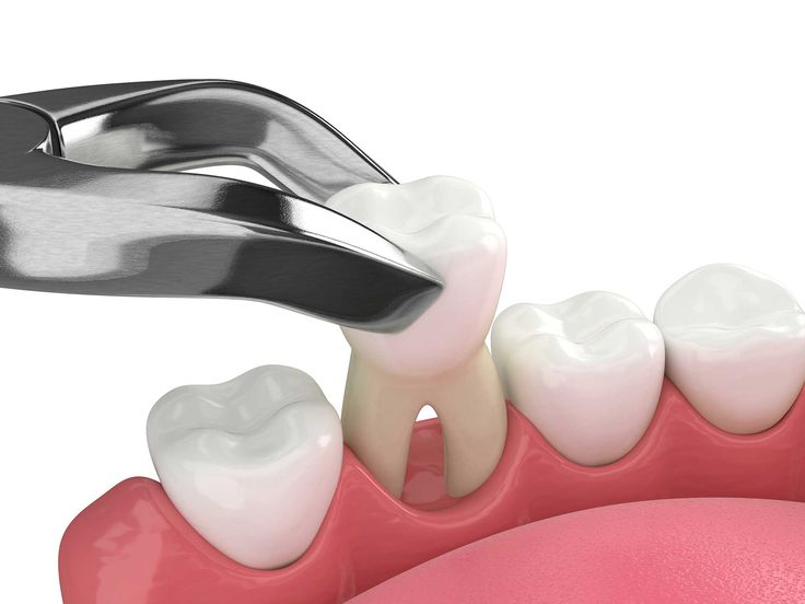 Tooth Extraction - Procedure, Risks, Aftercare & Recovery